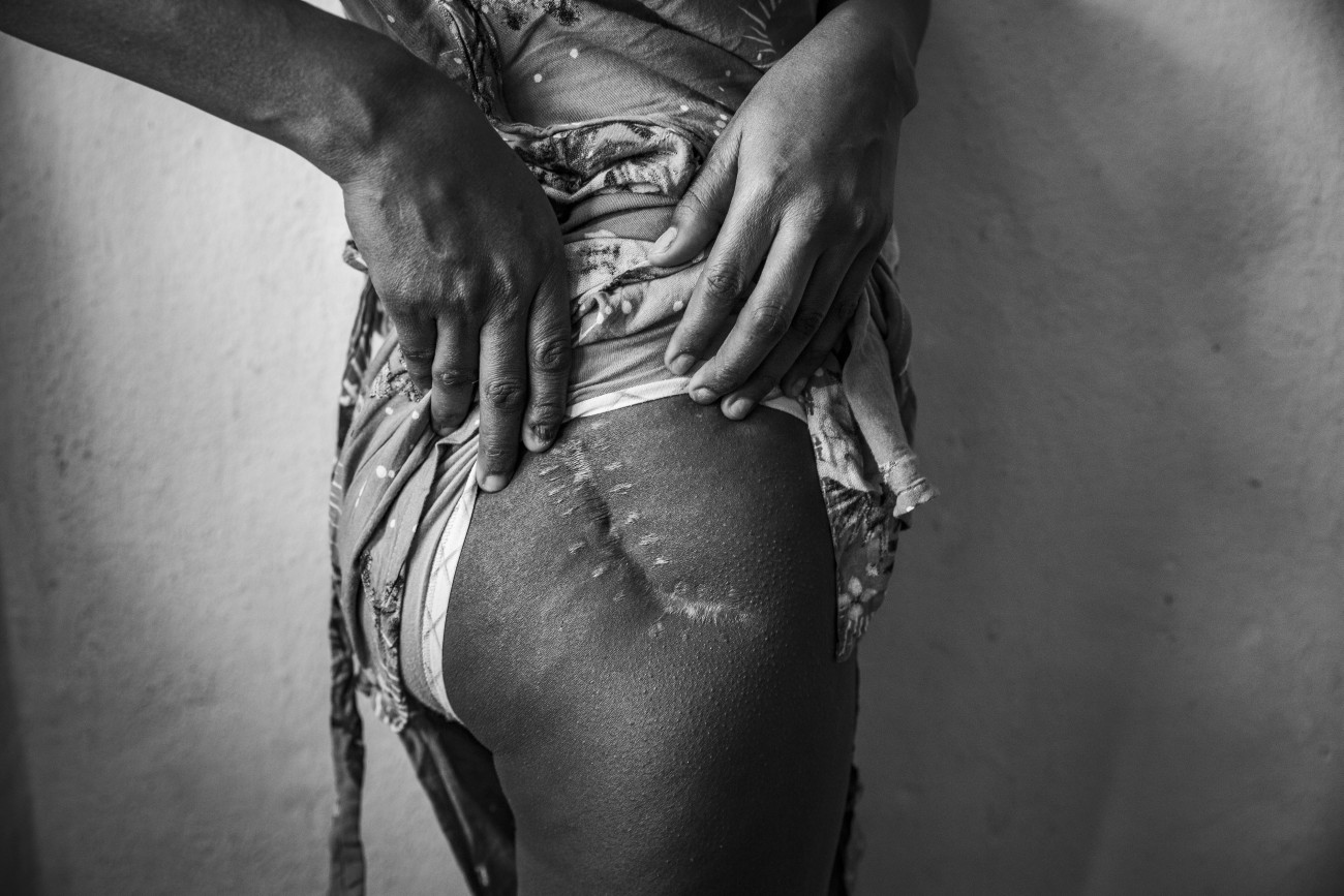 Woman in Ethiopia showing off a scar left by a bullet